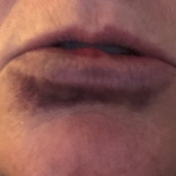 Schwartz Steven DDS - Never prepared me for the pain and bruising !! - Oral Surgeons Near Me - Port Jefferson Sta, New York Schwartz Steven DDS - Never prepared me for the pain and bruising !! - Oral Surgeons Near Me - Port Jefferson Sta, New York