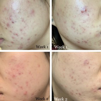 Clear Skin Solutions - Acne Treatment Near Me - Alhambra, California Clear Skin Solutions - Acne Treatment Near Me - Alhambra, California