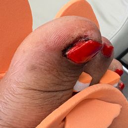 This is after she cut me.. and put nail glue on my toe to try and stop the bleeding! This is after she cut me.. and put nail glue on my toe to try and stop the bleeding!