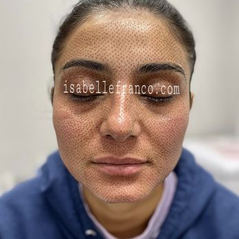 Isabelle Franco - Plasma Fibroblast Skin Tightening treatment.
Instagram isabellefranco_ #fibroblast - Permanent Makeup Near Me - Carlsbad, California Isabelle Franco - Plasma Fibroblast Skin Tightening treatment.
Instagram isabellefranco_ #fibroblast - Permanent Makeup Near Me - Carlsbad, California