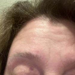Finishing Touches Head 2 Toe - Bruised eye due to eyebrow waxing