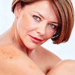 Lasting Impressions - Hyperpigmentation. Try Microdermabrasion or IPL skin rejuvenation to reduce dark spots.