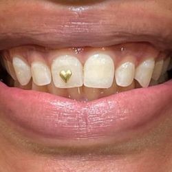 Teeth Gems