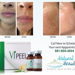 Natural Beauty Laser