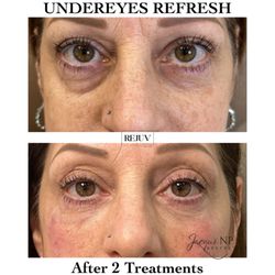 Rejuv Aesthetics & Wellness Spa - Under eye rejuvenation using filler