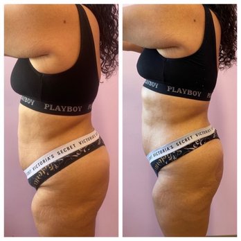 The Sculpting Studios - L: before, R: after - Body Contouring Near Me - Urban Honolulu, Hawaii The Sculpting Studios - L: before, R: after - Body Contouring Near Me - Urban Honolulu, Hawaii