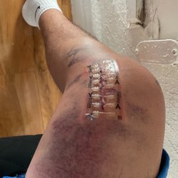 Alexander Orthopaedic Associates - SECOND FAILED attempt at removing a screw from my knee and a metal rod from my femur by Dr Alexander
