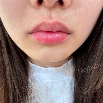 Skybaby Medspa - lip boosting after - Skin Care Near Me - New York, New York