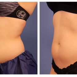 Northshore Skincare - Before and After CoolSculpting