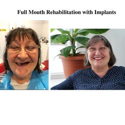 Diamond Dental - Full Mouth Rehabilitation with Implants