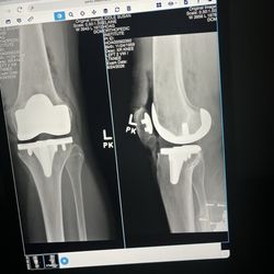 Stephen Mikulak, MD - New knee!