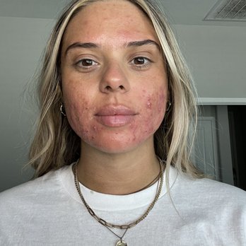 Savanna Boda - Before skincare routine - Skin Care Near Me - Coppell, Texas Savanna Boda - Before skincare routine - Skin Care Near Me - Coppell, Texas