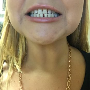 Pure Cypress Dentist - Before Dr Ash got a hold of my bottom teeth - General Dentistry Near Me - Cypress, California Pure Cypress Dentist - Before Dr Ash got a hold of my bottom teeth - General Dentistry Near Me - Cypress, California