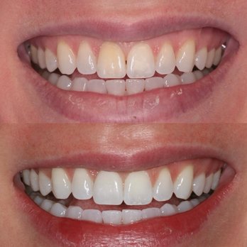 Michelle Ringwald, DMD - immediate implant placement, single front tooth restoration and teeth whitening transformed this woman's smile. - Cosmetic Dentists Near Me - Beverly Hills, California Michelle Ringwald, DMD - immediate implant placement, single front tooth restoration and teeth whitening transformed this woman's smile. - Cosmetic Dentists Near Me - Beverly Hills, California