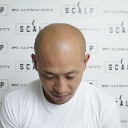 Scalp Society - Before photo in 2017