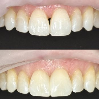 Stoneridge Dental - Closing "black triangles" with direct resin composite in a single, pain-free visit. - General Dentistry Near Me - Pleasanton, California Stoneridge Dental - Closing "black triangles" with direct resin composite in a single, pain-free visit. - General Dentistry Near Me - Pleasanton, California