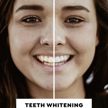 Swonke Dentistry - Dentist at champions forest and vintage park, teeth whitening or dental bleaching in office or take home trays. - General Dentistry Near Me - Spring, Texas Swonke Dentistry - Dentist at champions forest and vintage park, teeth whitening or dental bleaching in office or take home trays. - General Dentistry Near Me - Spring, Texas