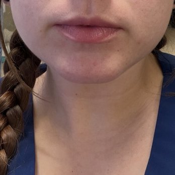 NakedMD - Before filler and lip flip - Medical Spas Near Me - Glendale, California
