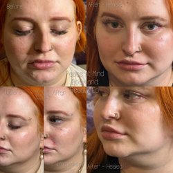 Peace at Mind Body and Beauty - Liquid facelift