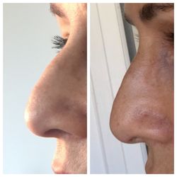 Non surgical rhinoplasty with Voluma filler.