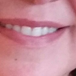 Richard J Reinitz, DDS -Dental Care of Pearland - Alignment of teeth before new crowns. No gaps.