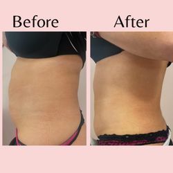 The Beauty Tender - Body Sculpting treatment