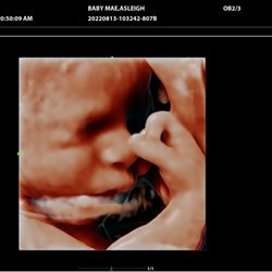 Peek A Boo Baby 3D 4D Ultrasound - 5D Face/Hand