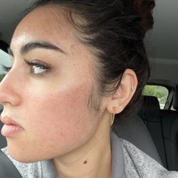 Top 2 Bottom Skincare - After microneedling acne scars, 4 treatments.