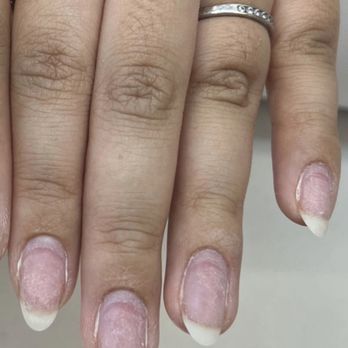 Oh My Nails - Nails damaged after gel overlay manicure.  Tech did not know how to use drill. Picture is after 3 weeks growth. - Nail Salons Near Me - Hayward, California