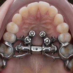 Ting Orthodontics - Custom MARPE