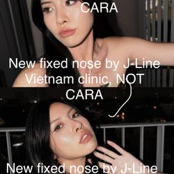 CARA Plastic Surgery & Laser Center - Healed nose by J-Line Vietnam at 3 months post revision!