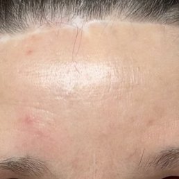 Brow lift results (visible scar and uneven eyebrows) Brow lift results (visible scar and uneven eyebrows)