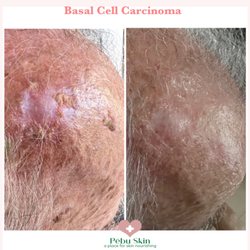 Pēbu Skin - Oncology Post Care . Repair Replenish Regenerate..