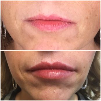 Rita Black, MD - Lips before and after, lip enhancement can be subtle, natural #juvaderm #lipenhancement #naturalresults #subtlelips #lipinjection #lipstick - Medical Spas Near Me - Orlando, Florida Rita Black, MD - Lips before and after, lip enhancement can be subtle, natural #juvaderm #lipenhancement #naturalresults #subtlelips #lipinjection #lipstick - Medical Spas Near Me - Orlando, Florida