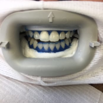 ProDental Hygiene LLC - AFTER - General Dentistry Near Me - Portland, Oregon ProDental Hygiene LLC - AFTER - General Dentistry Near Me - Portland, Oregon