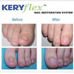 South Florida Podiatry - Damaged toenails? We can restore them!