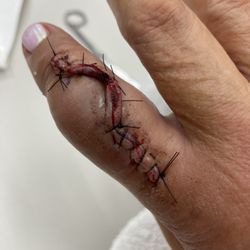 Straight after surgery