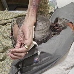 Trident Rehabilitation Center - My mom's bruised arm since they put the IV into her bone, and it took until the next day for them to remove it.