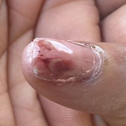 Badly damaged nail.