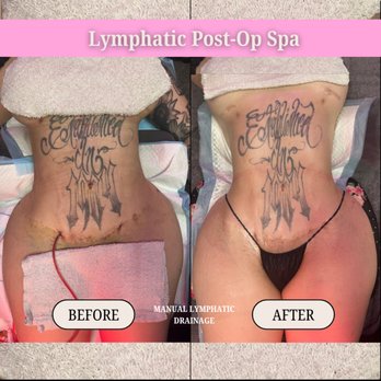 Lymphatic Post-Op Spa - Massage Near Me - San Diego, California Lymphatic Post-Op Spa - Massage Near Me - San Diego, California