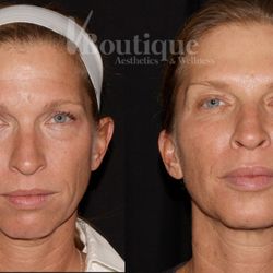 V Boutique Aesthetics & Wellness - Combination Therapy Before and After