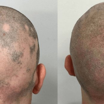 Micro Aesthetics - covered up alopecia - Hair Loss Centers Near Me - Boston, Massachusetts Micro Aesthetics - covered up alopecia - Hair Loss Centers Near Me - Boston, Massachusetts