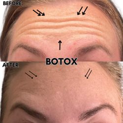 Luxury Recovery Spa - Botox