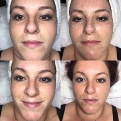 Glo European Skin Care - Before and after