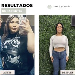 Nutrióloga Jessica Murguía  - Paciente: M. Lourdes
 Objetivo: Pérdida de peso (17 kg)
 Tiempo: 7 meses 
 Nota: Paciente disciplinada, entrenamiento en gimnasio