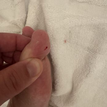 Bahia Resort Hotel - Result of finding out about carpet issue and needing a tetanus shot. - San Diego, CA