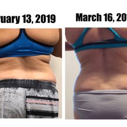Orlando Laser Lipo Services - Rosie's back treatments