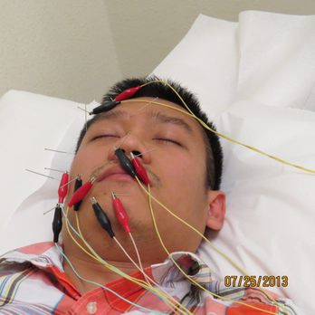Peter Hien Vo - Bell's Palsy Acupuncture - Acupuncture Near Me - San Jose, California Peter Hien Vo - Bell's Palsy Acupuncture - Acupuncture Near Me - San Jose, California