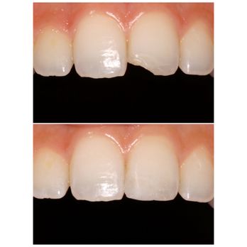 Jared Plitt, DMD - Cosmetic bonding - General Dentistry Near Me - Miami Beach, Florida Jared Plitt, DMD - Cosmetic bonding - General Dentistry Near Me - Miami Beach, Florida