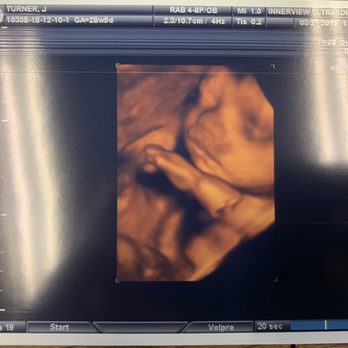 InnerView Ultrasound - 3D/4D Ultrasound - Ultrasound Imaging Centers Near Me - Malvern, Pennsylvania InnerView Ultrasound - 3D/4D Ultrasound - Ultrasound Imaging Centers Near Me - Malvern, Pennsylvania